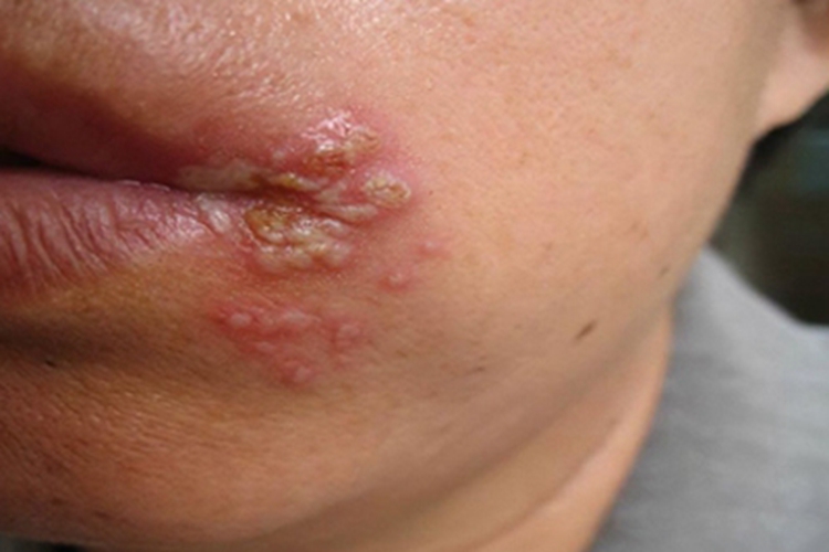 唇疱疹口周结痂图