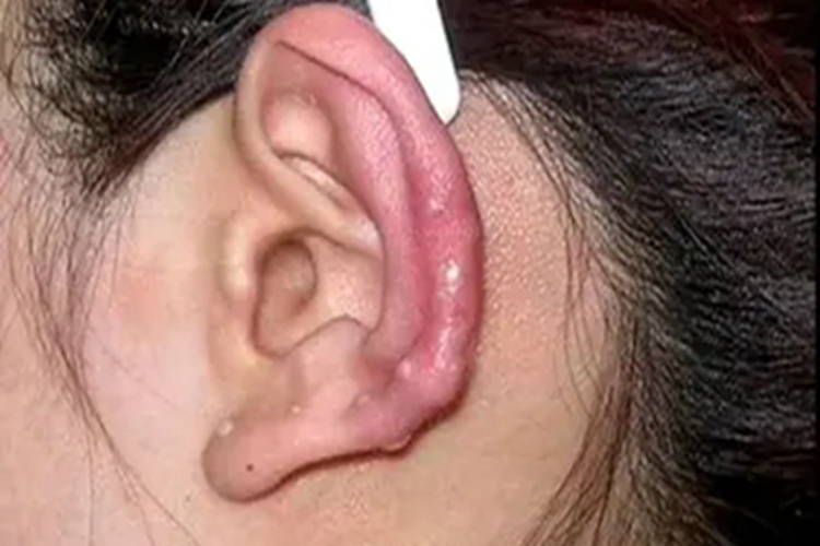 耳廓软骨膜炎耳廓小疙瘩图