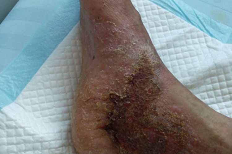 脓窝疮脚踝黄痂图 脓窝疮脚踝黄痂图