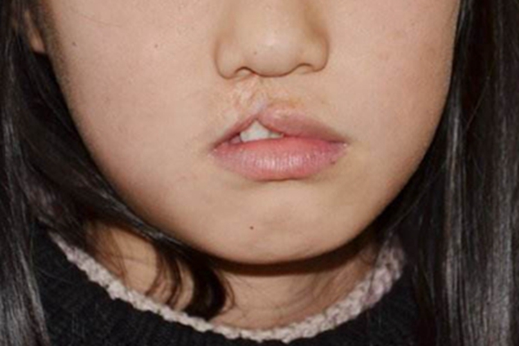 唇腭裂上嘴唇缺了一块图