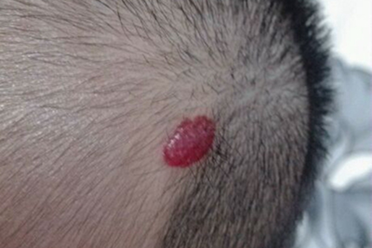 蔓状血管瘤头皮小红疙瘩图