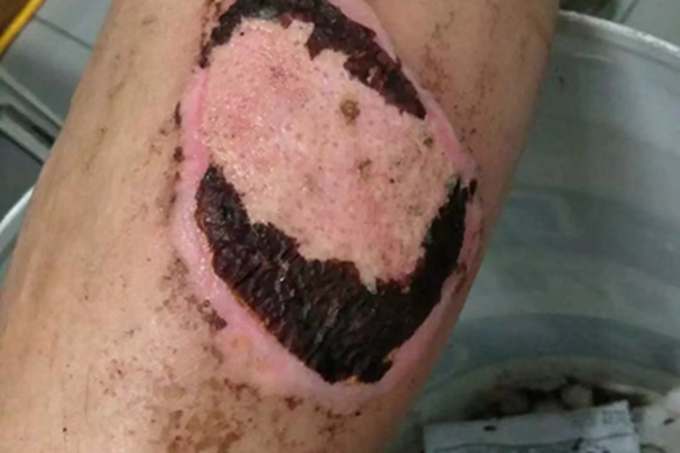 烫伤黑痂图 烫伤黑痂图
