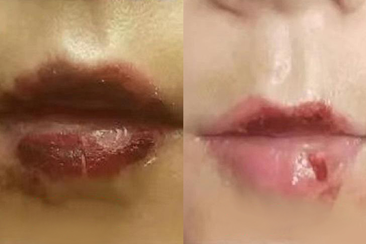 半永久唇后期恢复过程图