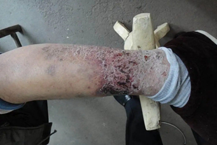 淤积性皮炎小腿糜烂图 淤积性皮炎小腿糜烂图