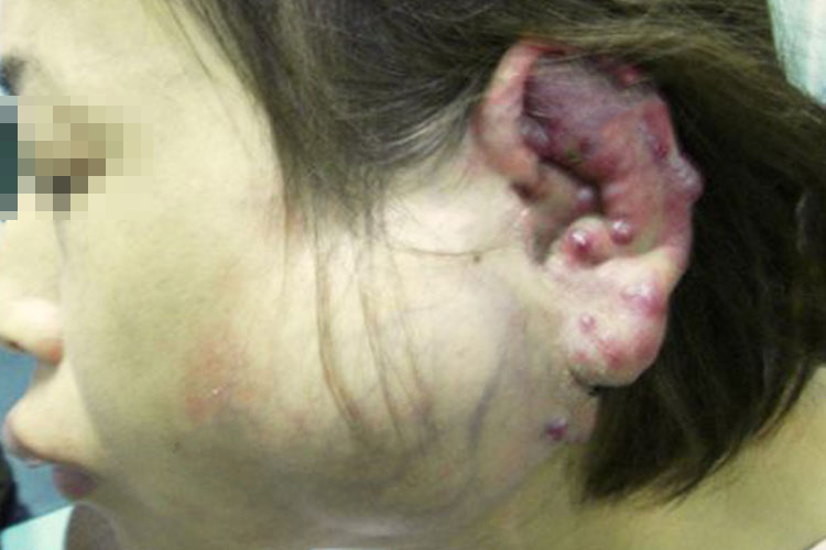 血管瘤-海绵状血管瘤 血管瘤-海绵状血管瘤