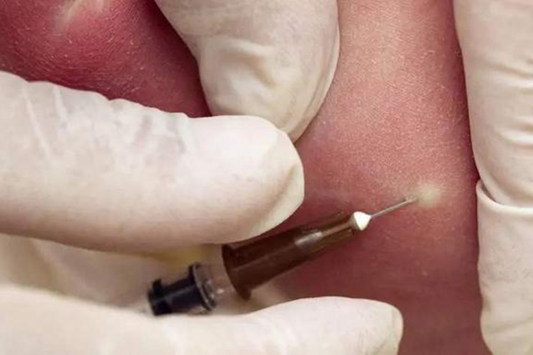 皮内注射方法图 皮内注射方法图