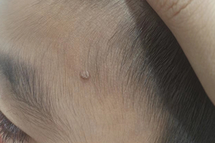 寻常疣前额症状图 寻常疣前额症状图