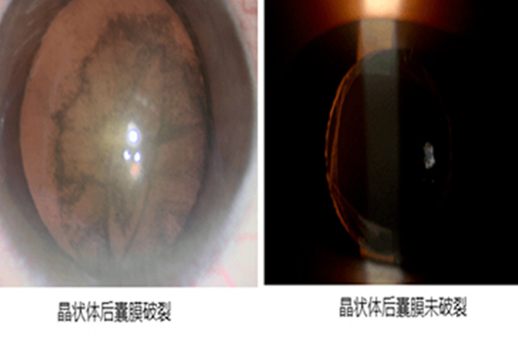 晶状体后囊膜破裂与未破裂图