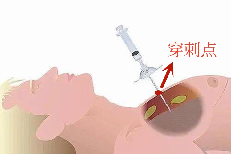 气胸引流位置图