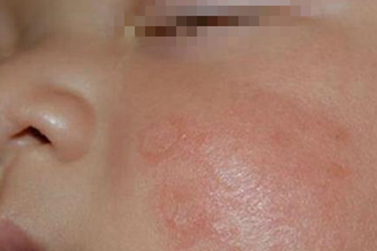 面癣脸上一片小红疙瘩图