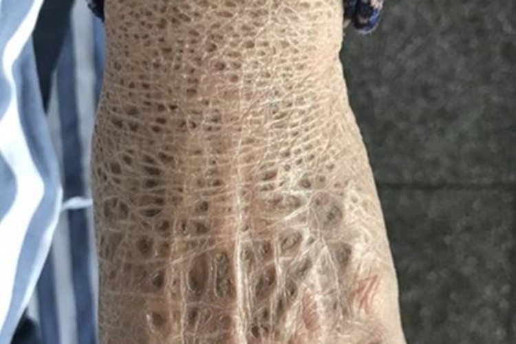 鱼鳞病手背症状图