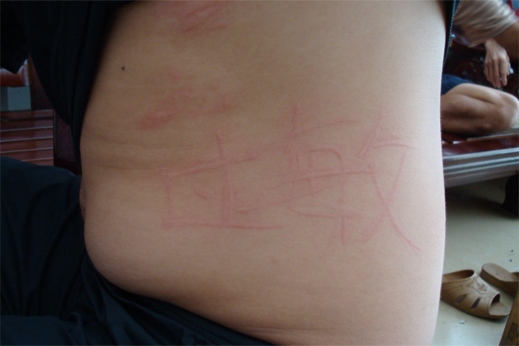 诱导性荨麻疹皮损图 诱导性荨麻疹皮损图