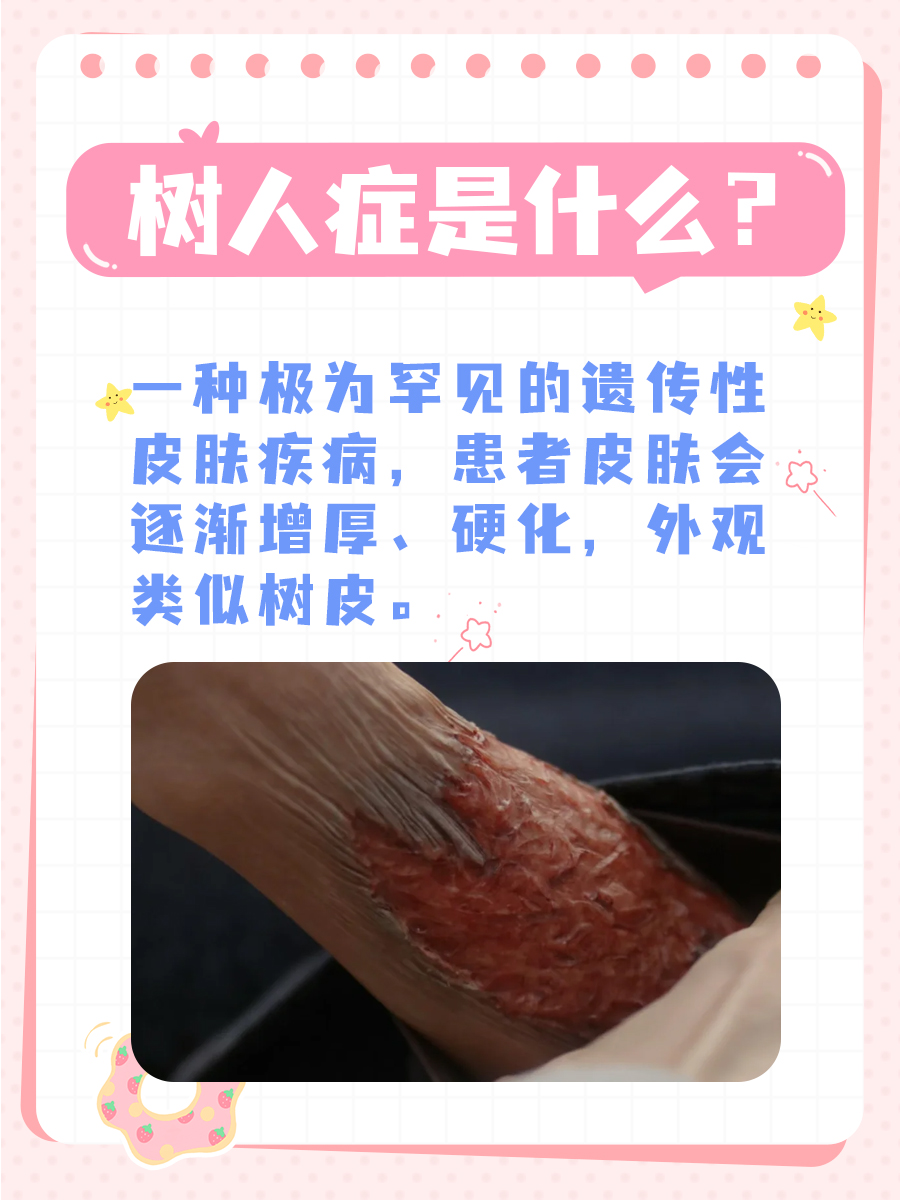 罕见树人症揭秘:皮肤变“树皮”?一文来解答!