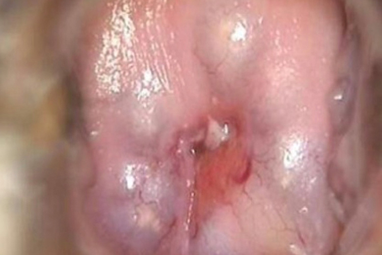 纳氏囊肿图 纳氏囊肿图