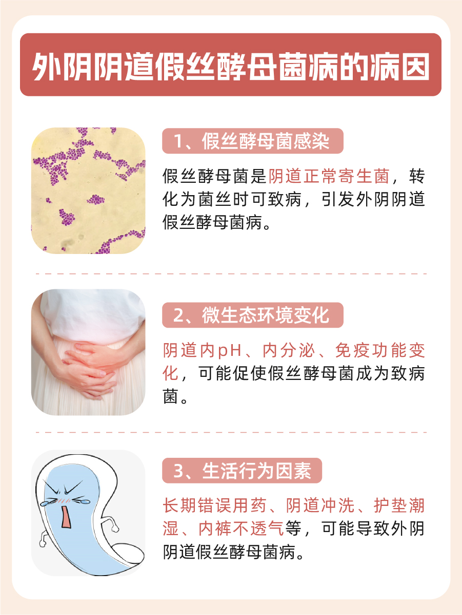 外阴阴道假丝酵母菌病长期不治会癌变吗，一文解析