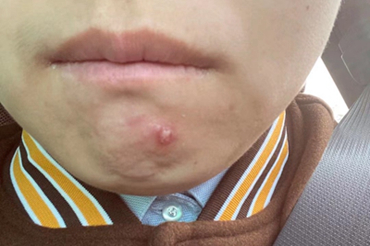 颜面疖痈下巴大包图