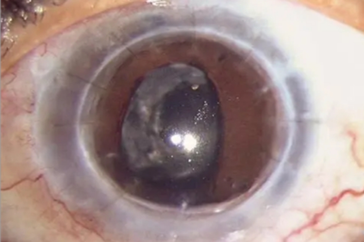 典型性虹膜缺损眼球呈梨形图