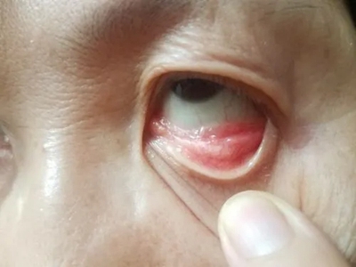 慢性细菌性结膜炎下眼睑内充血发红图