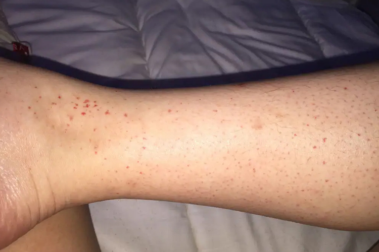 艾滋病滞血斑图