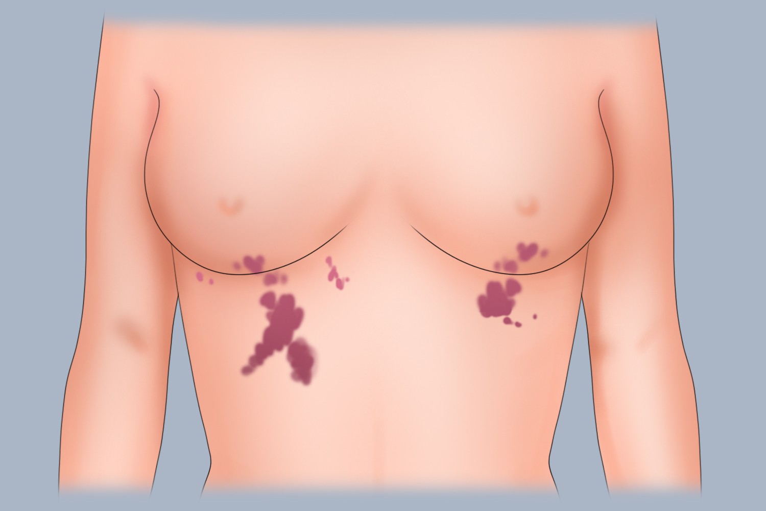 鲜红斑痣胸下红斑图