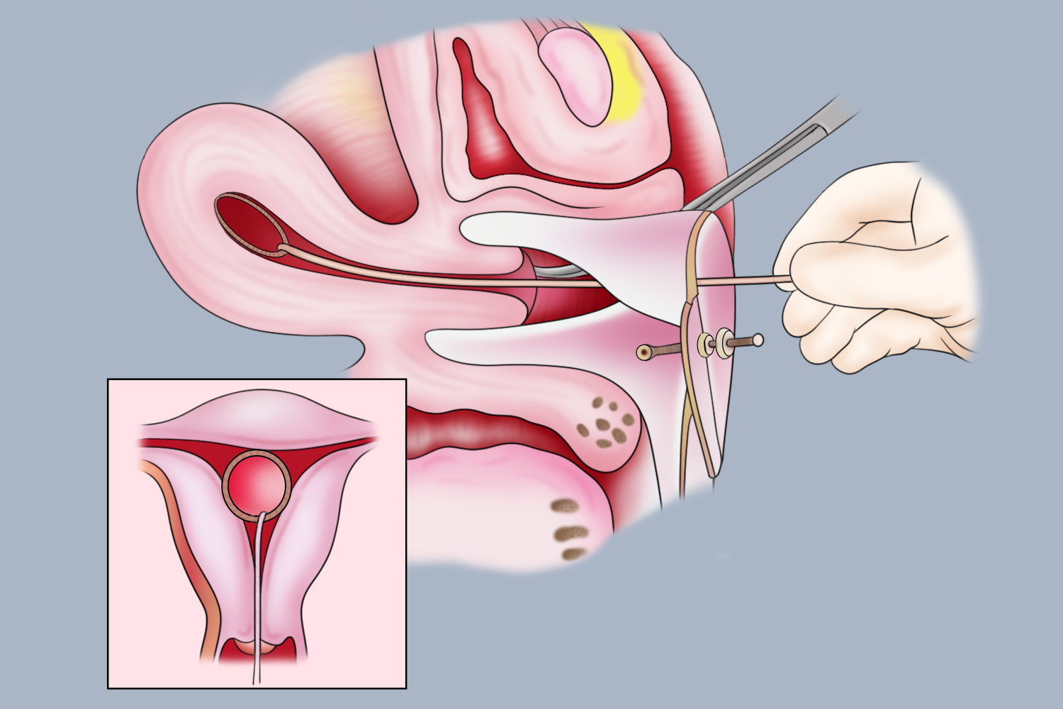 取环钩钩取O型环过程图 取环钩钩取O型环过程图
