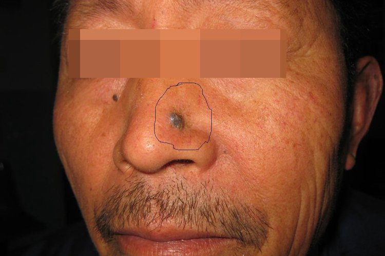 色素型基底细胞癌图