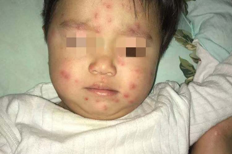 孩子面部初期水痘图