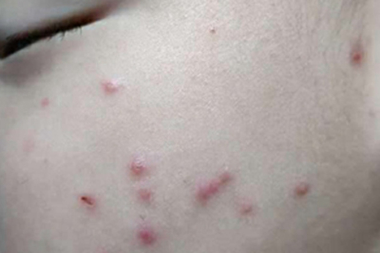 儿童痒疹型皮损图