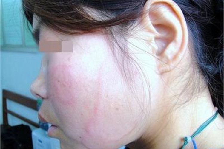 未定类型麻风面部红斑图