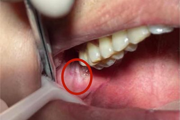 创伤性溃疡口腔症状图