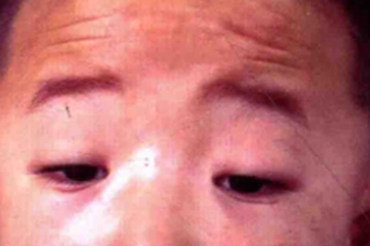 先天性上睑下垂眼皮向下耷拉图 先天性上睑下垂眼皮向下耷拉图