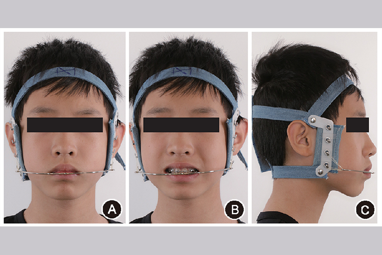 口外弓矫正治疗图 口外弓矫正治疗图