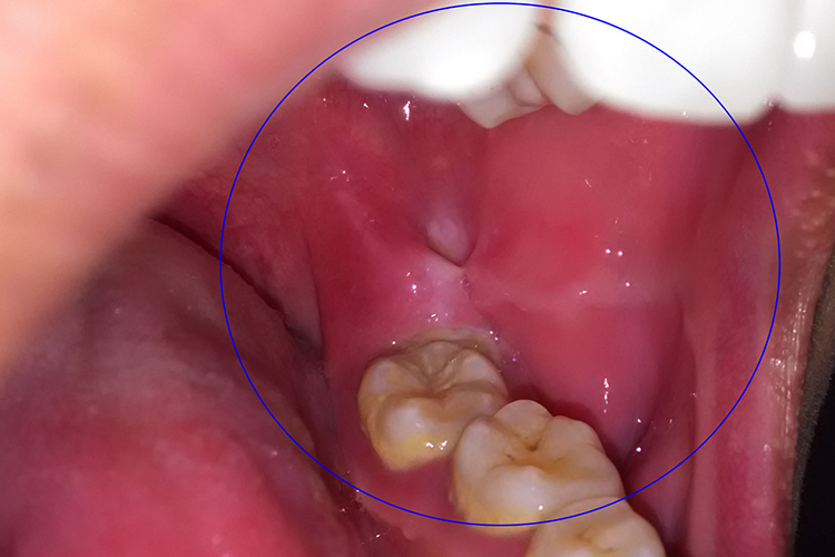 药物过敏性口炎图 药物过敏性口炎图