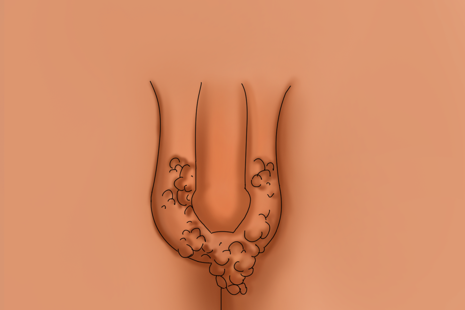 男性晚期性病性淋巴肉芽肿手绘图