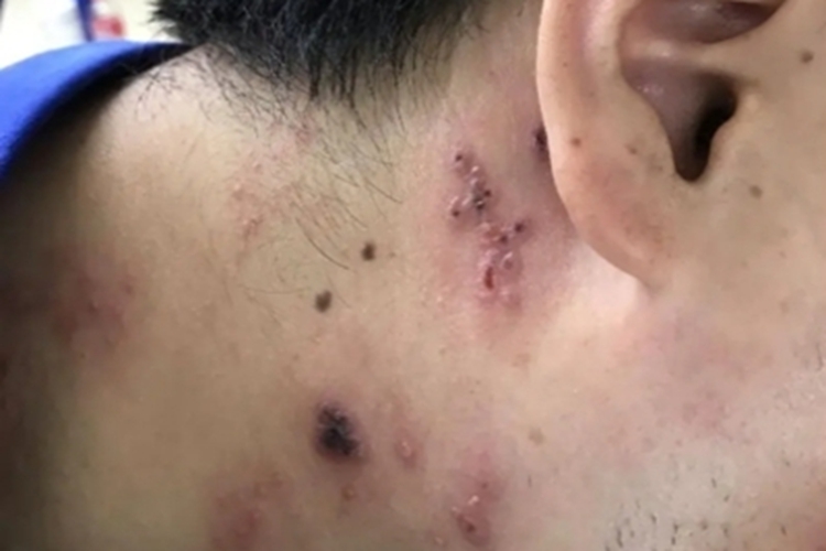 播散性马尔尼菲青霉病侧颈结痂图 播散性马尔尼菲青霉病侧颈结痂图