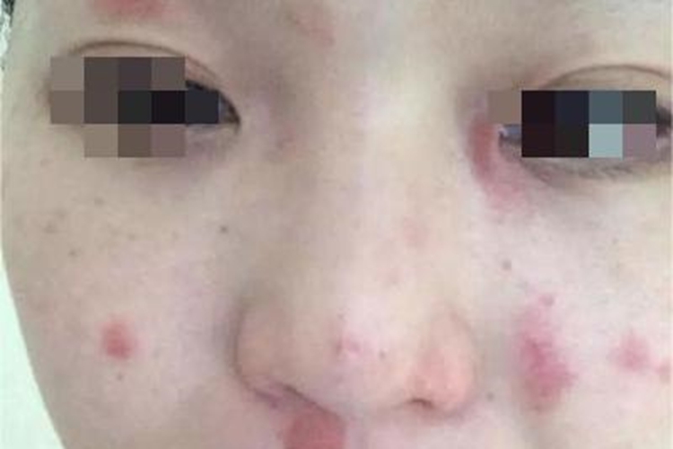 界限类偏瘤型麻风面部症状图