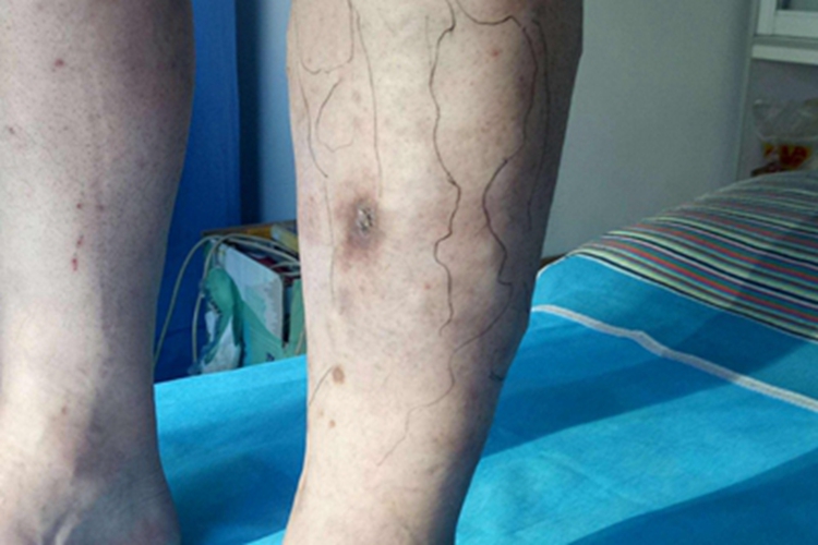 下肢静脉曲张小腿色素沉着图