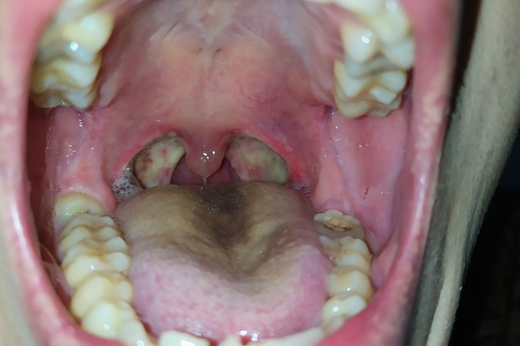 术后10天白膜逐渐脱落图 术后10天白膜逐渐脱落图