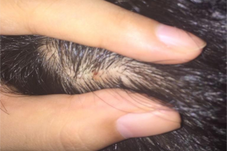 疣状角化不良瘤小疙瘩图 疣状角化不良瘤小疙瘩图