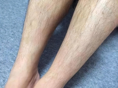妇女多毛症小腿的汗毛又黑又长图