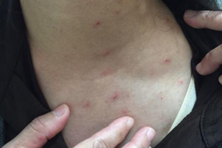 恙螨皮炎颈部症状图 恙螨皮炎颈部症状图