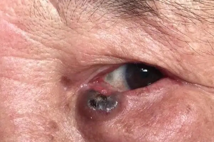 眼睛肿瘤图片大全