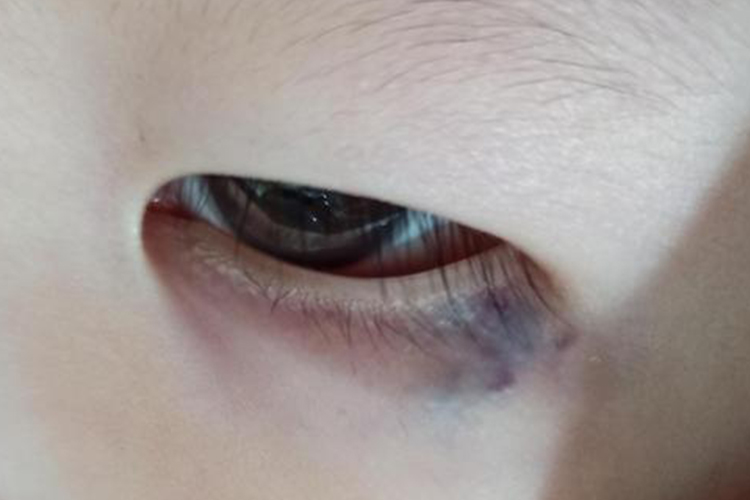 眼外伤导致下眼皮发紫图