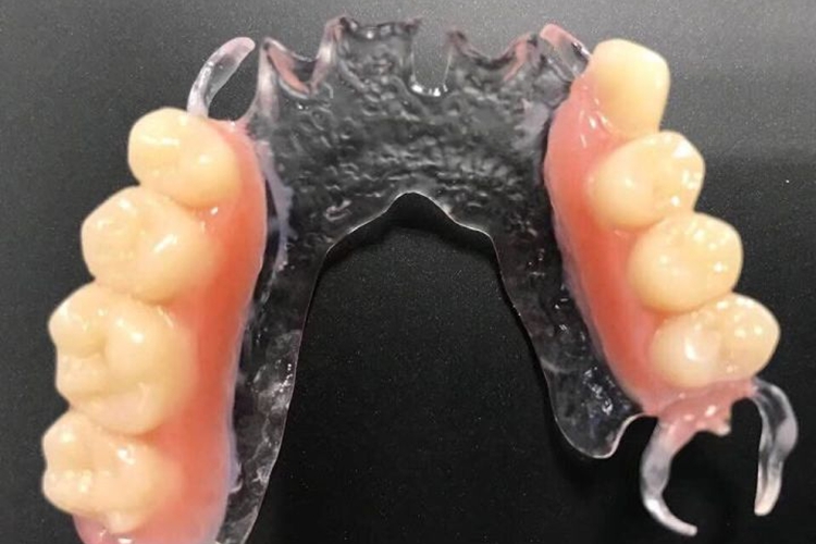 树脂基托可摘局部义齿图