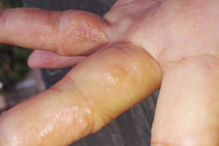 脓疱病手指缝水疱图 脓疱病手指缝水疱图
