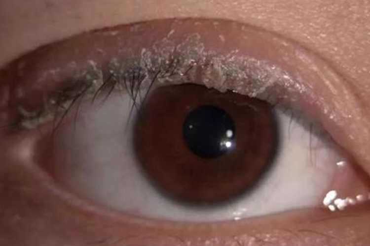 鳞屑性睑缘炎图