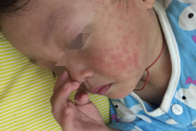 小儿风疹图 小儿风疹图