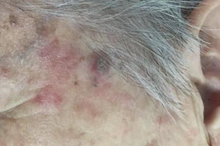 老年性角化病颞部症状图