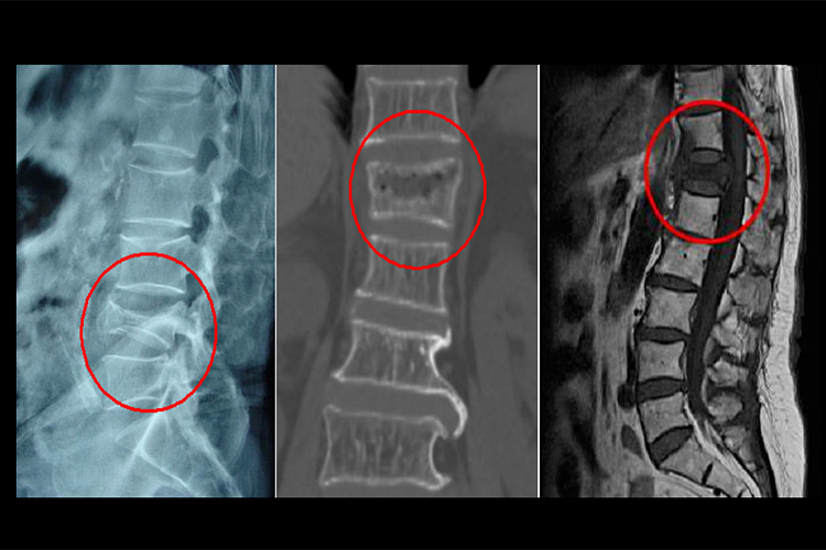 肾癌血行转移至骨骼图