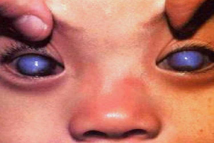 婴儿青光眼混浊图